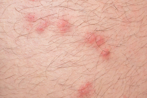 Flea bites on skin