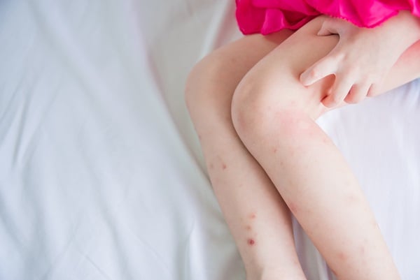 bed bug bite scars on legs