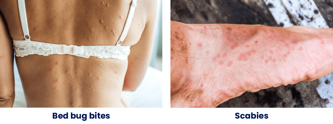 Identifying Bed Bugs Bites: Signs, Symptoms, and Prevention