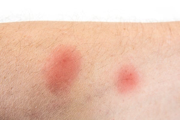 Spider bite on skin