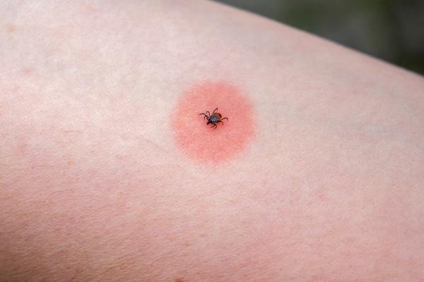 Tice Bug How to Identify a Tick Bite: Signs and Symptoms