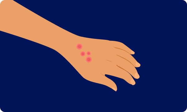 Bite marks