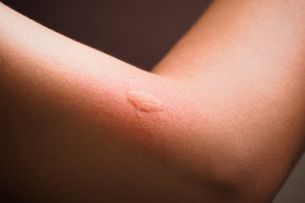 Mosquito bite on arm