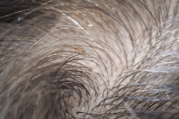 Lice walking on human head