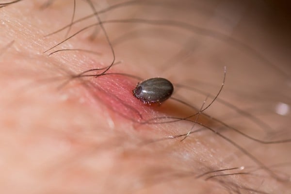 Tick embedded in human skin