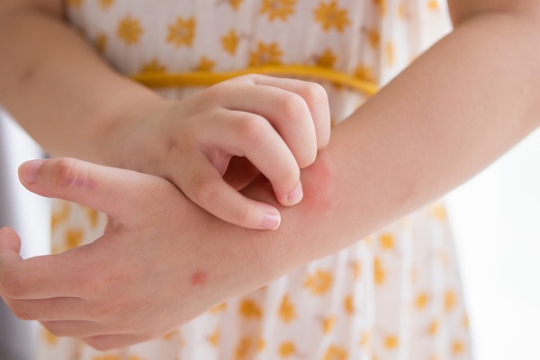 girl itching mosquito bites